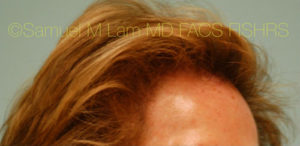 Female Hair Restoration