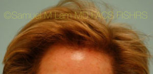 Female Hair Restoration