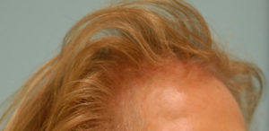 Female Hair Restoration