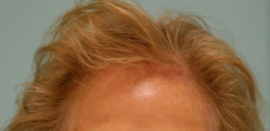 Female Hair Restoration
