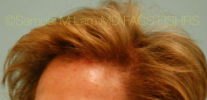 Female Hair Restoration