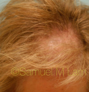 Female Hair Restoration