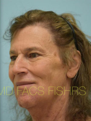 Transgender Hair Transplant
