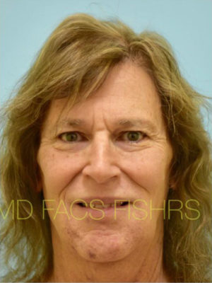 Transgender Hair Transplant