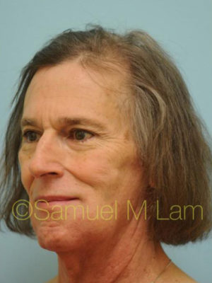 Transgender Hair Transplant