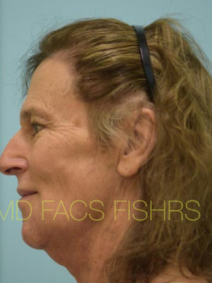 Transgender Hair Transplant