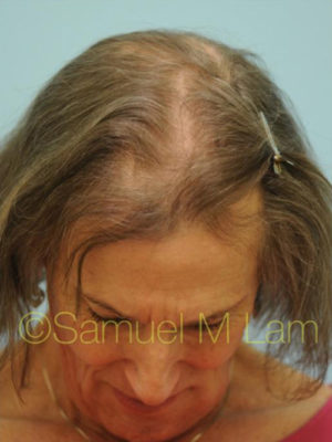 Transgender Hair Transplant