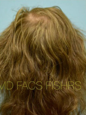 Transgender Hair Transplant