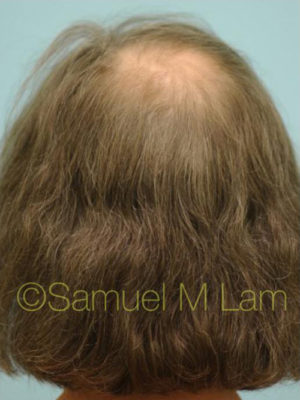 Transgender Hair Transplant
