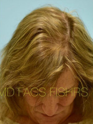Transgender Hair Transplant