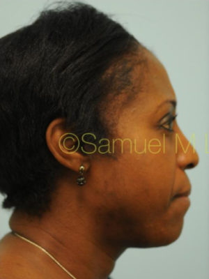 Eyebrow Hair Restoration
