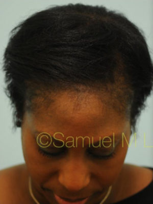 Eyebrow Hair Restoration