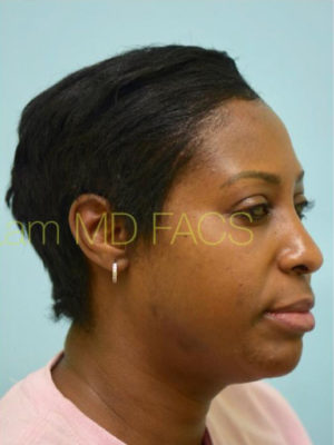 Eyebrow Hair Restoration