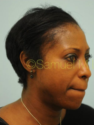 Eyebrow Hair Restoration