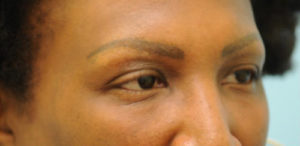 Eyebrow Hair Restoration