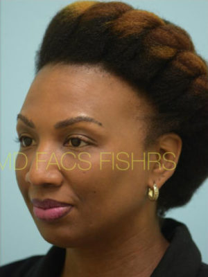 Eyebrow Hair Restoration