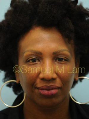 Eyebrow Hair Restoration