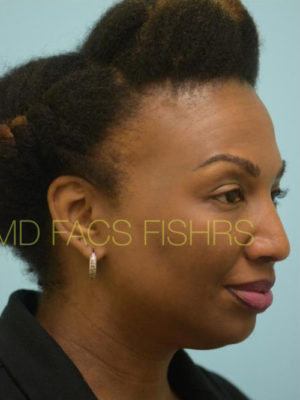 Eyebrow Hair Restoration