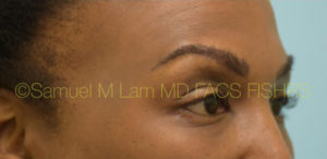 Eyebrow Hair Restoration