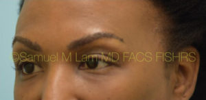 Eyebrow Hair Restoration