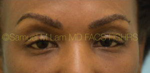 Eyebrow Hair Restoration