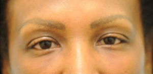 Eyebrow Hair Restoration