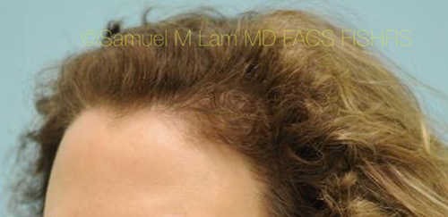 Female Hairline Lowering