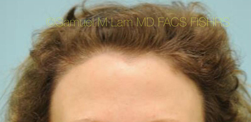 Female Hairline Lowering