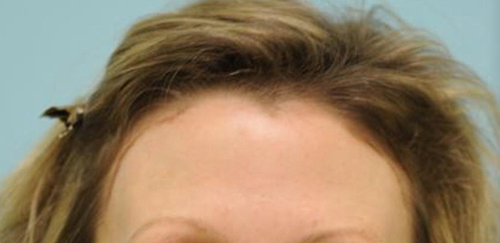 Female Hairline Lowering