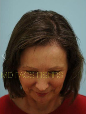 Female Hair Restoration