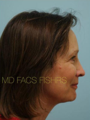 Female Hair Restoration