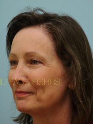 Female Hair Restoration