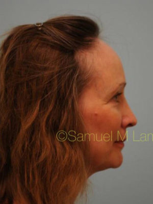 Female Hair Restoration