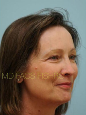 Female Hair Restoration