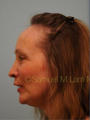 Female Hair Restoration