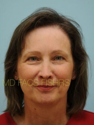 Female Hair Restoration