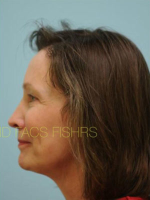 Female Hair Restoration