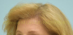 Female Hairline Lowering