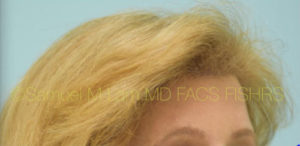 Female Hairline Lowering