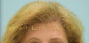 Female Hairline Lowering