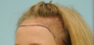 Female Hairline Lowering