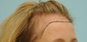 Female Hairline Lowering