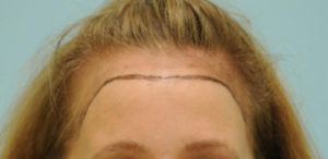 Female Hairline Lowering