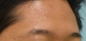 Eyebrow Hair Restoration