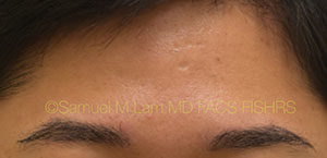 Eyebrow Hair Restoration