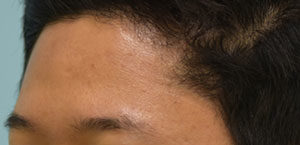 Eyebrow Hair Restoration