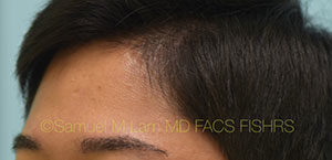 Eyebrow Hair Restoration