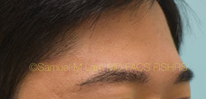 Eyebrow Hair Restoration