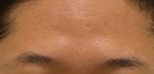 Eyebrow Hair Restoration
