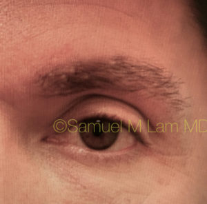 Eyebrow Hair Restoration